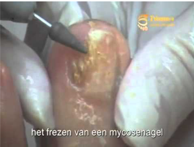 frezen mycosenagel